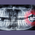 Wisdom Tooth Removal - Avoid the waiting time