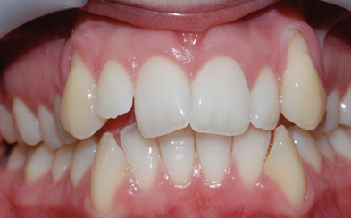 before1 - Gipsy Lane Orthodontics Reading