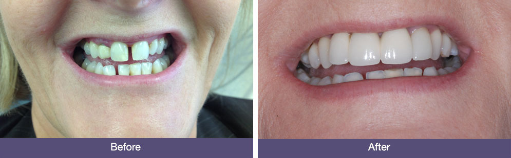Before ad AFter DEntal Implants