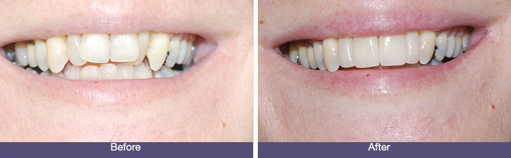 D Batchelor before and after dental implants